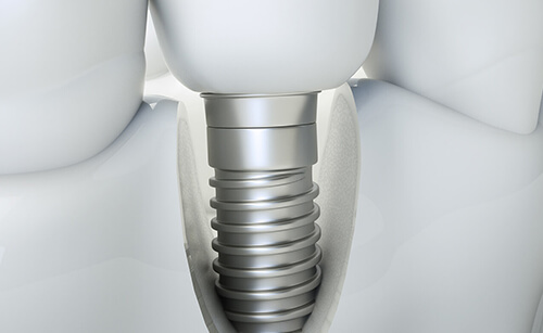 Fogászati Implantáció