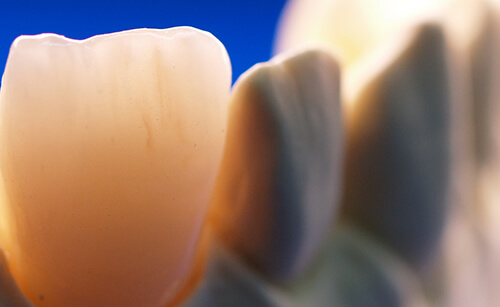 Zahnkronen in Ungarn, Sopron