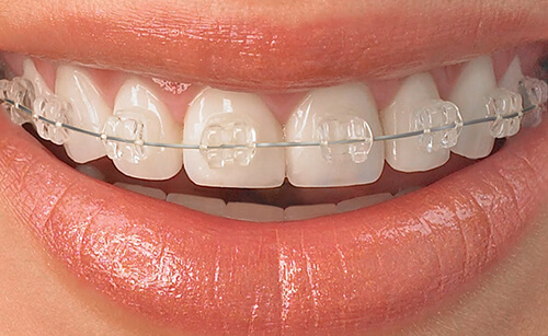 Zahnspange in Ungarn