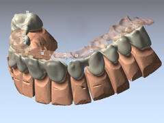 Zahntechnik 3D Plan Software Zahnersatz