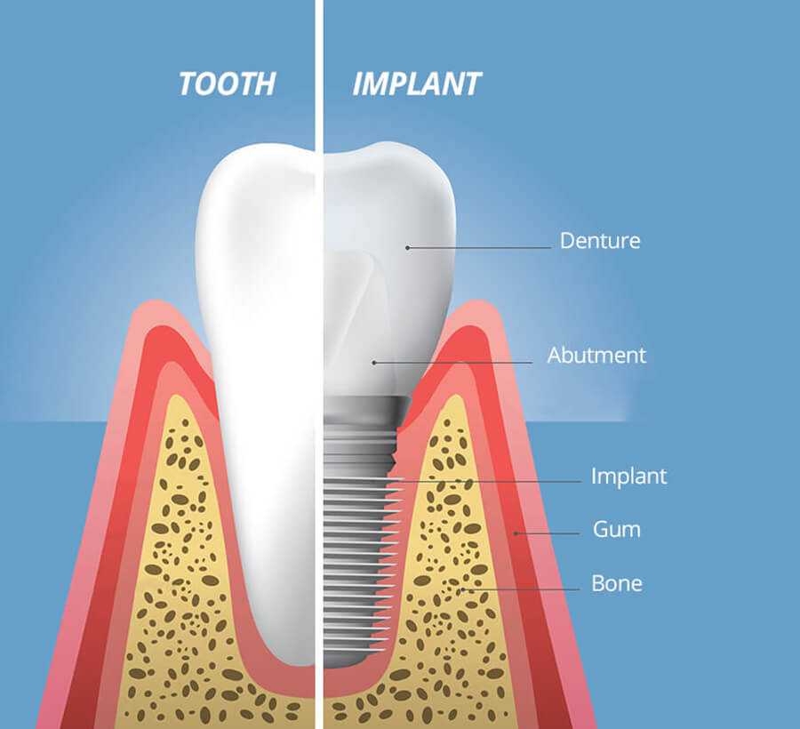 Dental Implant Structure