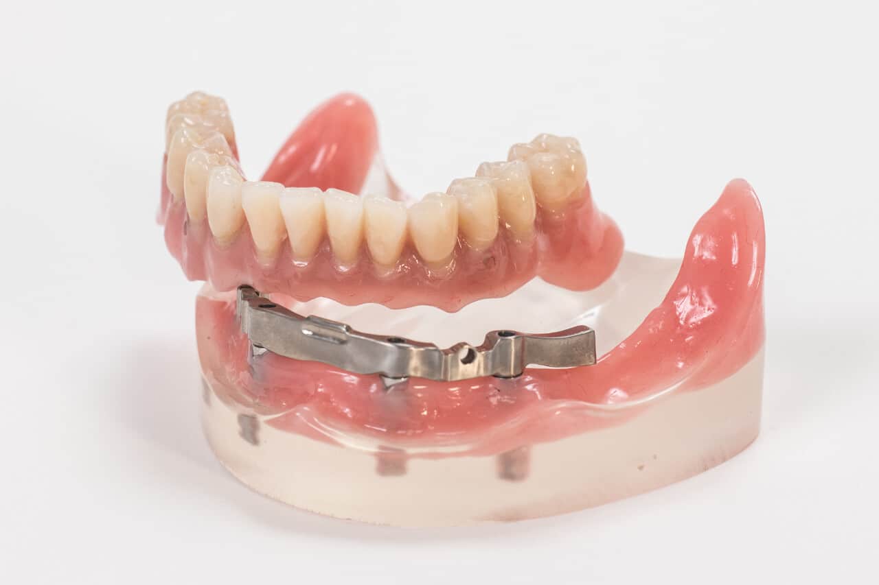 Riegelverankerte Prothese auf Implantaten